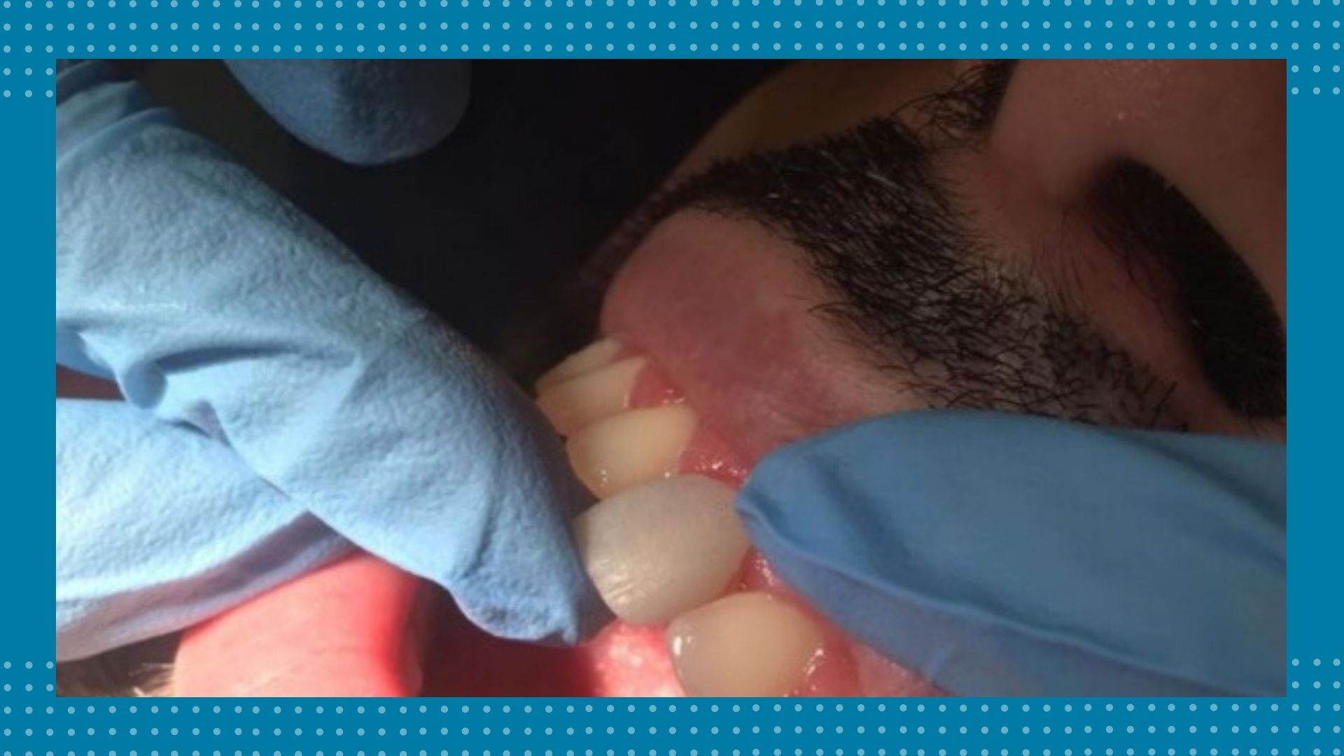 Colocación de carillas dentales, tratamiento de estética