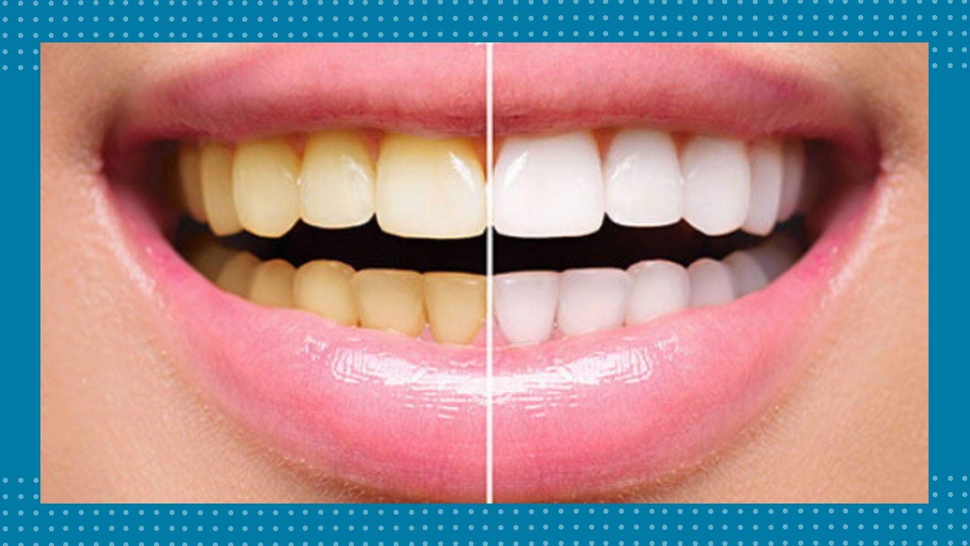 Antes y después de un blanqueamiento dental profesional en BF Estética Dental