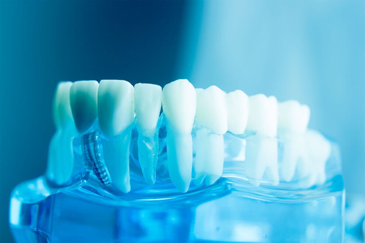 Modelo de implante dental y raíces, tratamiento de implantología en BF Estética Dental