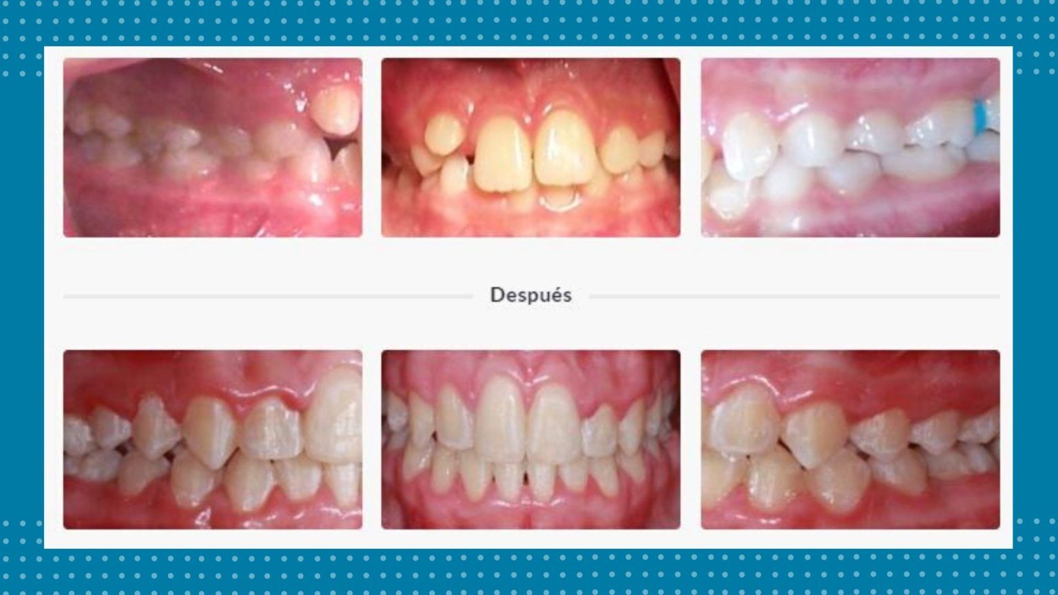 Antes y después de un tratamiento de ortodoncia en BF Estética Dental