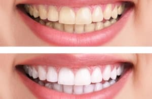 Antes y después de blanqueamiento dental en Clínica Sonrilaser