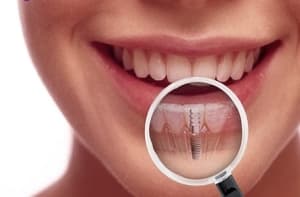 Implante dental bajo lupa, Clínica Sonrilaser Cúcuta