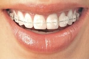 Brackets de ortodoncia en tratamiento, Clínica Sonrilaser Cúcuta