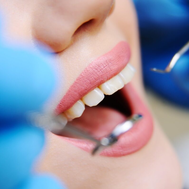 Detalhe de aparelho ortodôntico fixo em sorriso