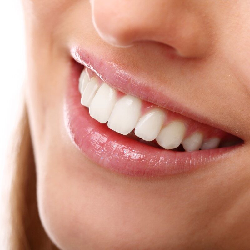 Sorriso com dentes alinhados após tratamento odontológico