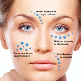 Ilustração das áreas de aplicação de preenchimento facial