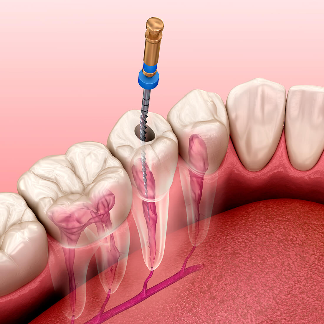 Ilustración 3D de un tratamiento de conducto en una pieza dental