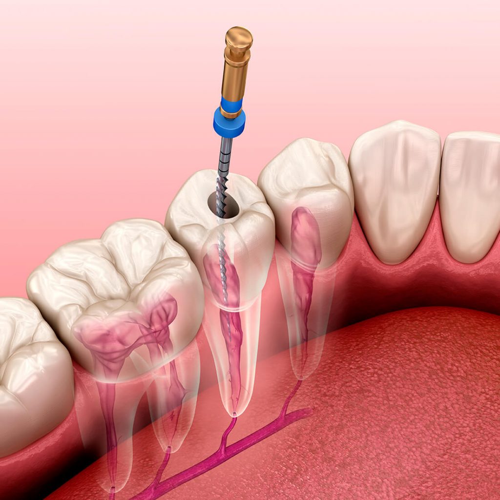 Detalle de un tratamiento de endodoncia