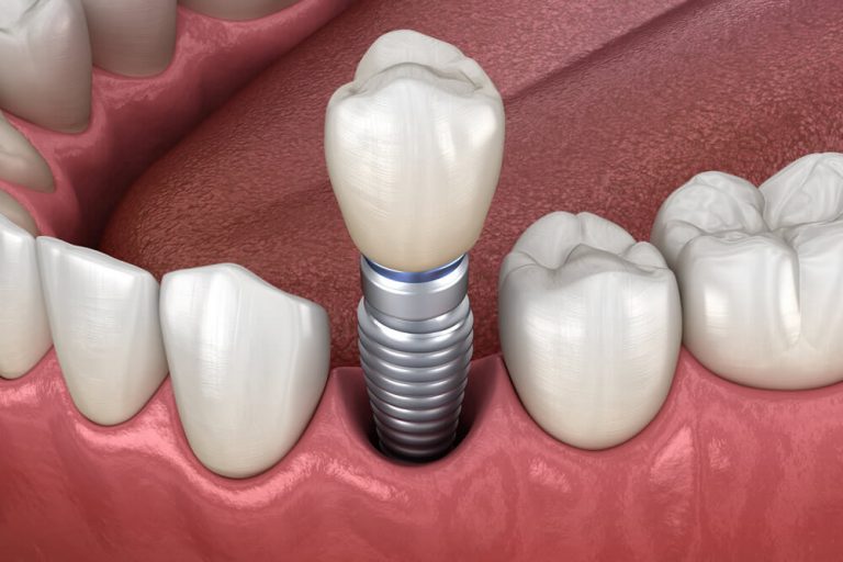 Modelo de un implante dental de titanio