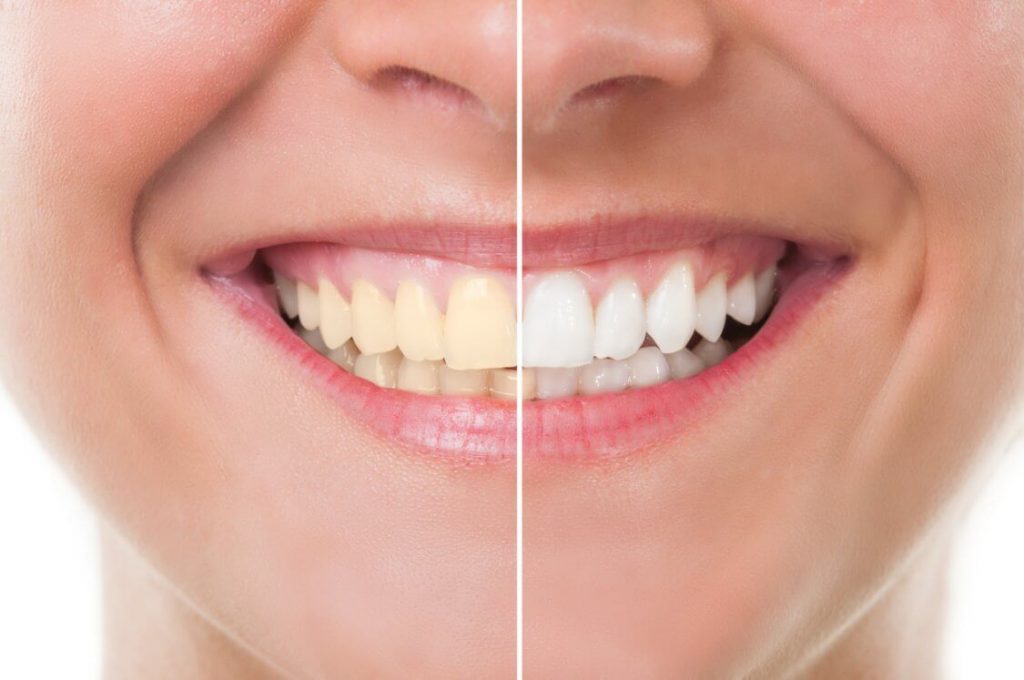 Sonrisa antes y después de un tratamiento estético dental