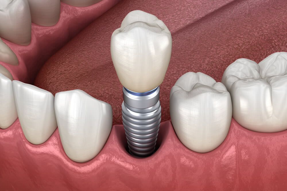 Modelo 3D de un implante dental de titanio integrado en la encía