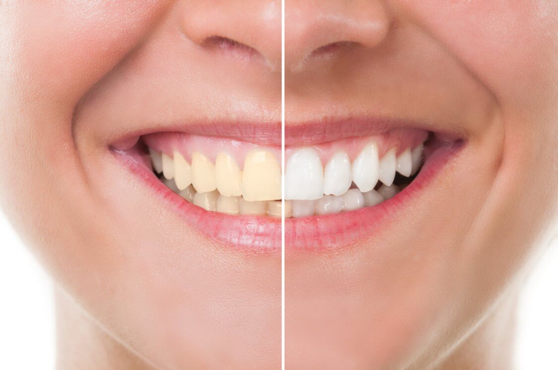Comparación de una sonrisa antes y después de una rehabilitación estética