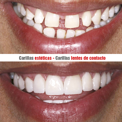 Antes y después de carillas estéticas realizadas en el Consultorio Dental Piura