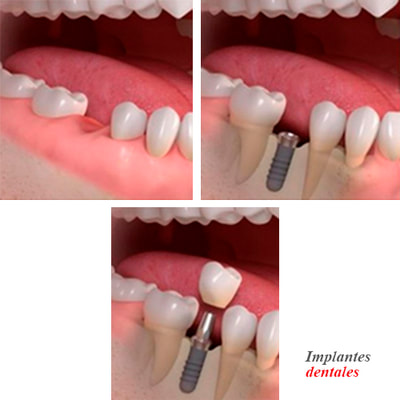 Proceso de colocación de un implante dental en el Consultorio Dental Piura