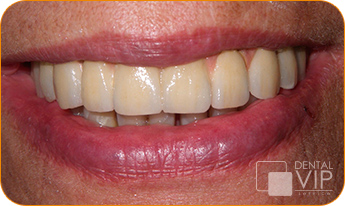 Sonrisa de paciente real de Dental VIP Service después de un tratamiento de rehabilitación dental