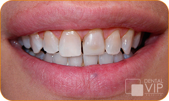 Sonrisa real de paciente antes de tratamiento estético en Dental VIP Service