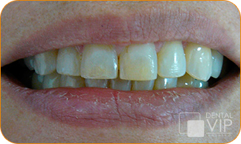 Sonrisa real de otro paciente antes de tratamiento en Dental VIP Service
