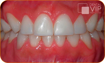 Sonrisa real de paciente después de tratamiento de ortodoncia en Dental VIP Service