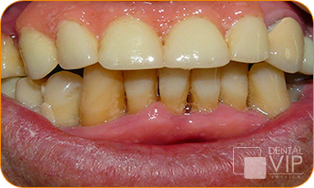 Radiografía real de caso de implante dental antes del tratamiento en Dental VIP Service