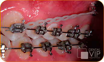 Detalle real de brackets de ortodoncia en tratamiento activo