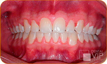 Sonrisa real de paciente con dentadura alineada tras finalizar ortodoncia