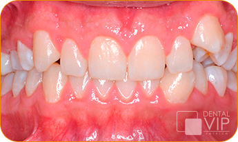 Vista intraoral real de arcada dental sana en control de Dental VIP Service