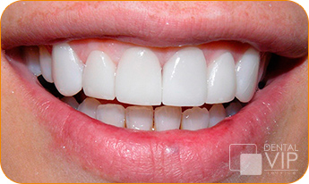 Resultado real de diseño de sonrisa y carillas dentales en paciente de Dental VIP Service