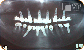 Radiografía panorámica real de implantes dentales colocados en paciente de Dental VIP Service