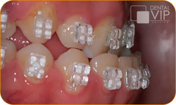 Detalle real de brackets de ortodoncia en tratamiento en Dental VIP Service