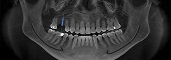 Radiografía panorámica para planificación digital de implantes dentales