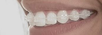 Brackets estéticos transparentes alineando la sonrisa