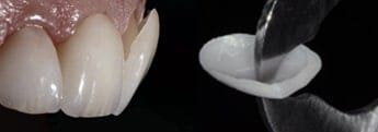 Colocación de carillas de porcelana para rehabilitar la sonrisa