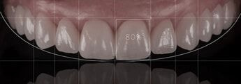 Diseño digital de sonrisa con medición milimétrica de las piezas