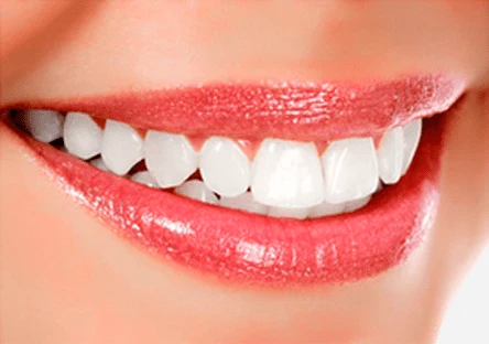 Sonrisa restaurada con dientes alineados y naturales