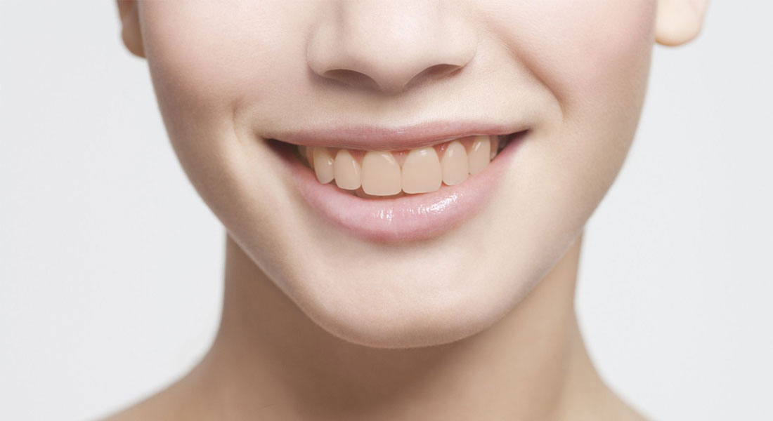 Sonrisa de una paciente antes de un tratamiento de blanqueamiento dental, caso real de Divina Sonrisa