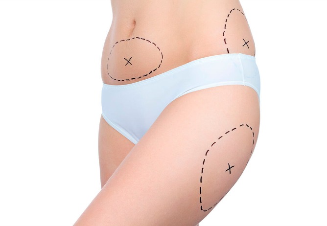 Marcación quirúrgica sobre abdomen y muslo previa a una cirugía de contorno corporal