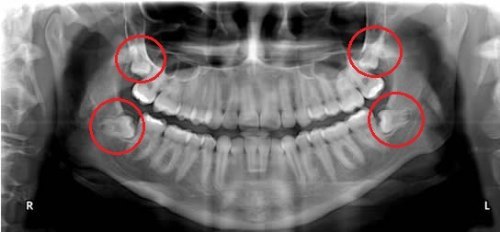 Radiografía panorámica para planificar la extracción de terceros molares en OdontoCúcuta