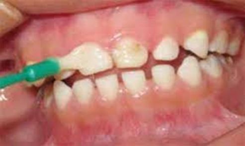 Limpieza e higiene dental profesional realizada en OdontoCúcuta