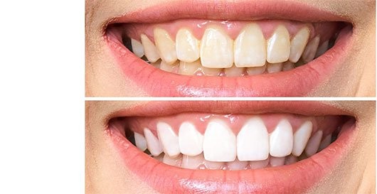 Comparação de dentes antes e depois de clareamento dental na Orodental