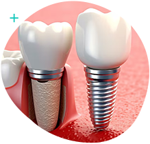 Modelo de implante dentário de titânio utilizado na Orodental