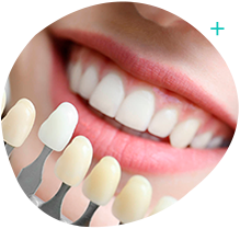Lentes de contato dental (facetas) de porcelana utilizadas na Orodental