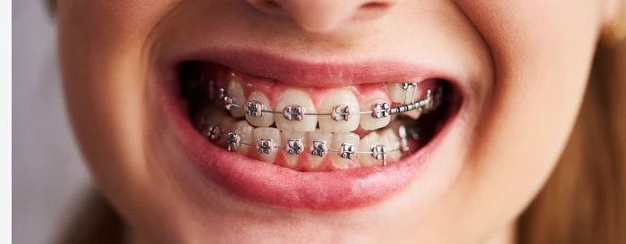 Sorriso com aparelho ortodôntico, tratamento realizado na Orodental