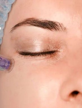 Detalle de tratamiento facial con Dermapen en Paula Andrea Osorio Spa